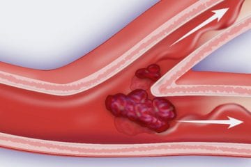 Illustration of a mini stroke.